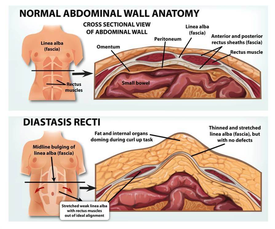 diagram of abdominal wall muscles