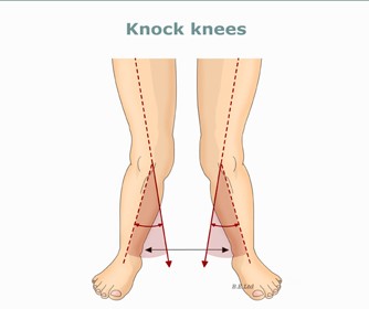 diagram shows what leg position is knock knees