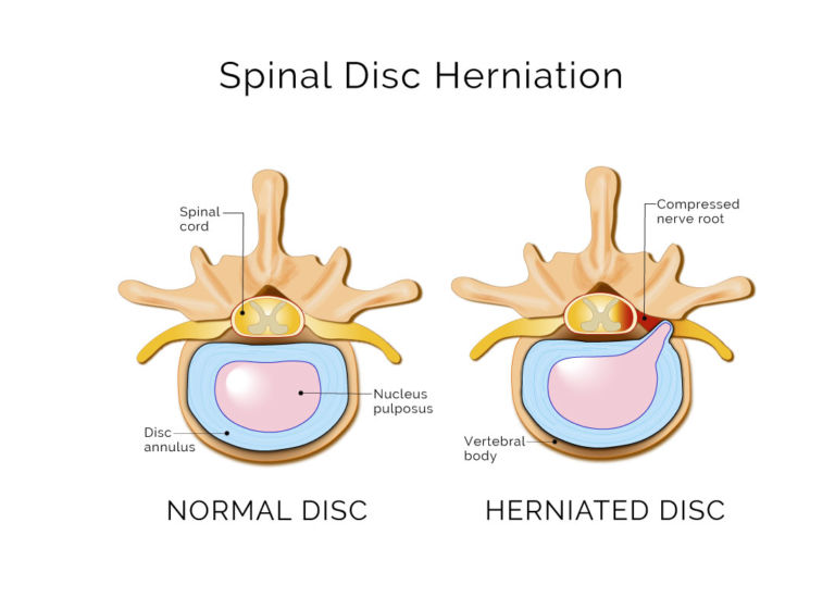 Spinal-Disc-Herniation