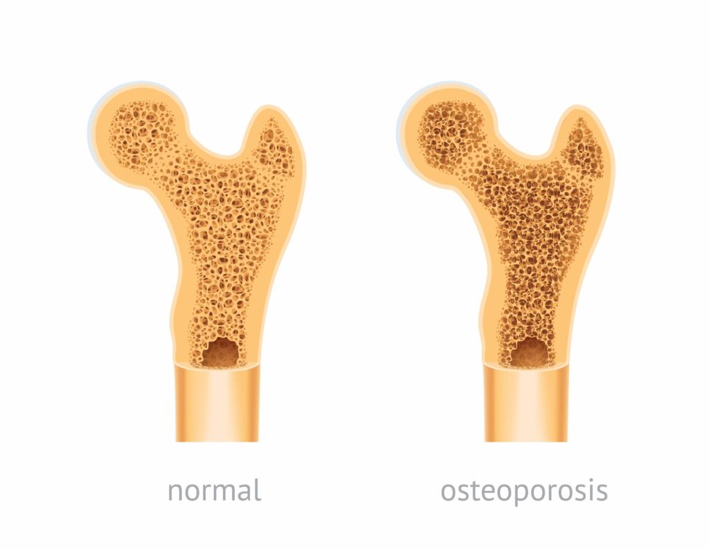 healthy bone vs osteoporosis bone