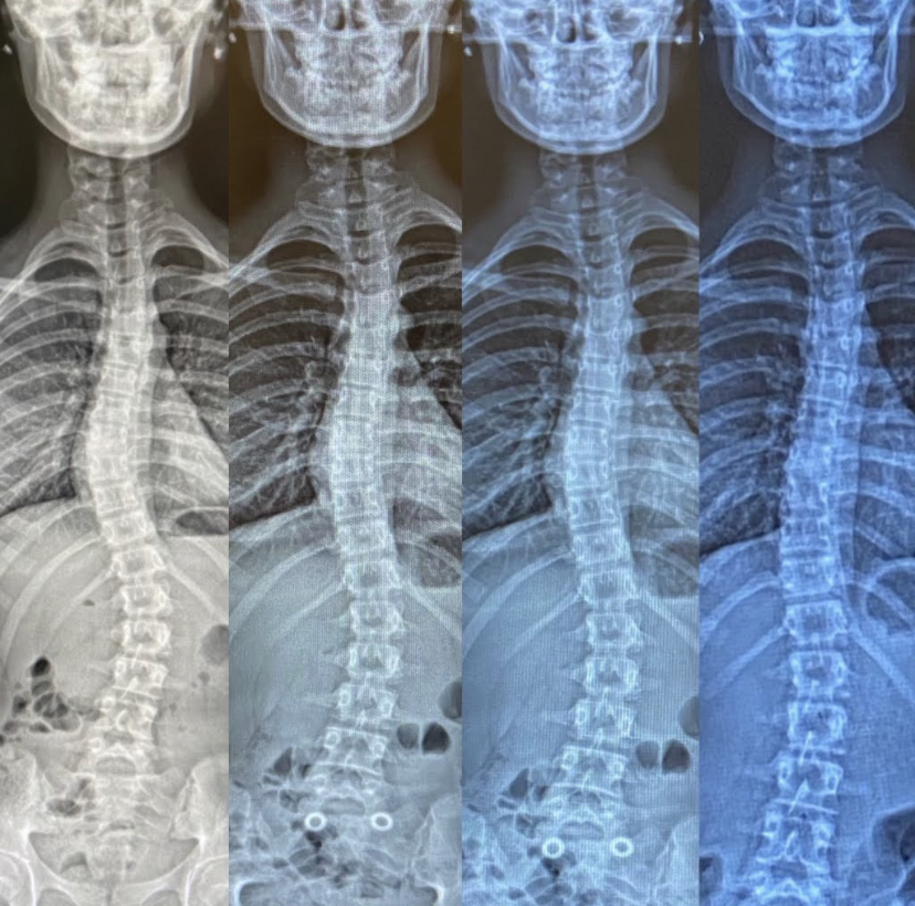x-ray showing progressive improvement for pediatric scoliosis