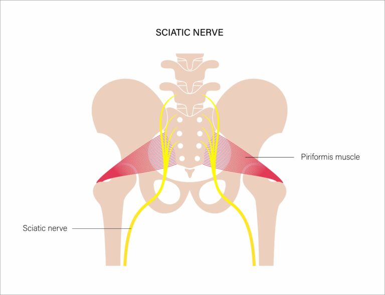 Can Physical Therapy Relieve Sciatica Pain?