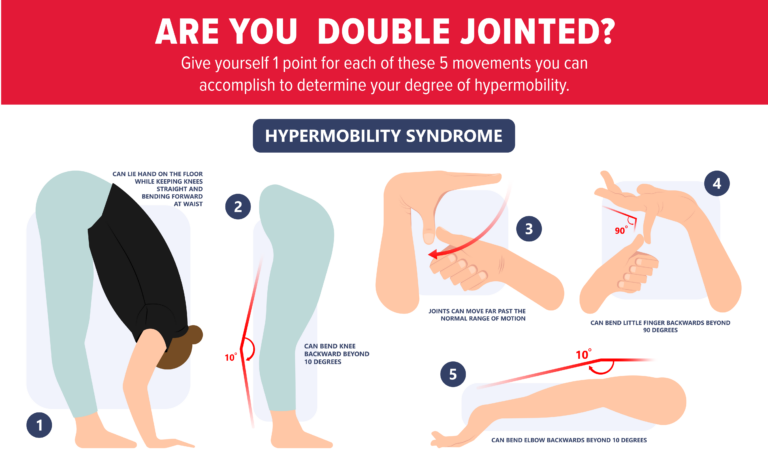 The Beighton Scoring System illustration of maneuvers to test hypermobility of joints