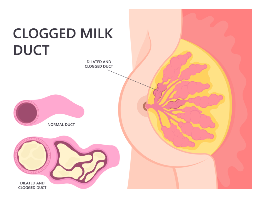 illustration of a clogged milk duct