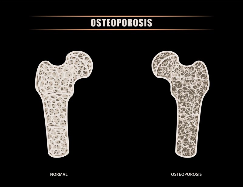 illustration of what osteoporosis looks like in a bone