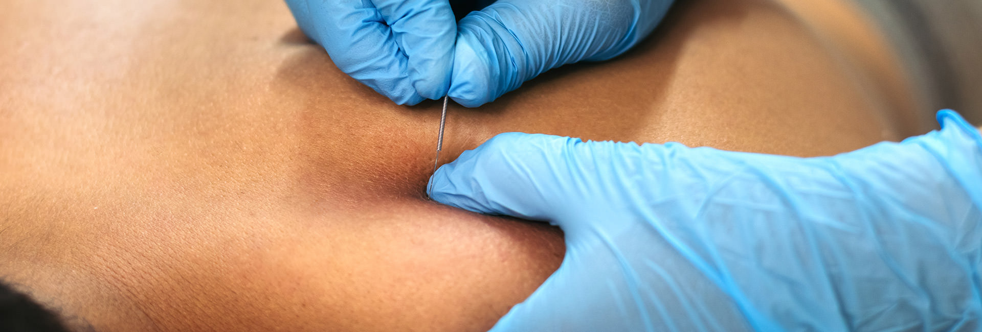 Dry-Needling---Therapeutic-Associates-Physical-Therapy